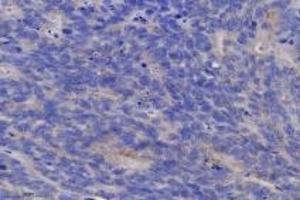 Immunohistochemistry analysis of paraffin-embedded human colon cancer using TGT (ABIN7076024) at dilution of 1: 6400 (tRNA-Guanine Transglycosylase anticorps)