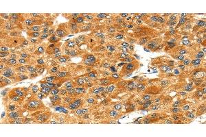 Immunohistochemistry of paraffin-embedded Human liver cancer tissue using STXBP4 Polyclonal Antibody at dilution 1:40 (STXBP4 anticorps)