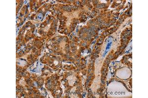 Immunohistochemistry of Human cervical cancer using MBNL3 Polyclonal Antibody at dilution of 1:30 (MBNL3 anticorps)