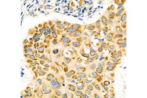 Immunohistochemistry of paraffin embedded human lung cancer using Notch4 (ABIN7074863) at dilution of 1:600 (400x lens) (NOTCH4 anticorps)