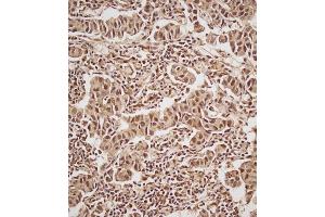 Immunohistochemical analysis of (ABIN657470 and ABIN2846498) on paraffin-embedded Human breast carcinoma tissue. (Estrogen Receptor alpha anticorps  (AA 246-273))