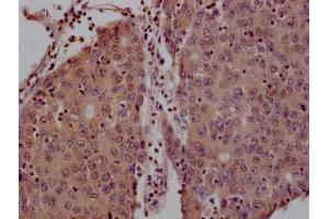 IHC image of ABIN7142109 diluted at 1:200 and staining in paraffin-embedded human liver cancer tissue performed on a Leica BondTM system.