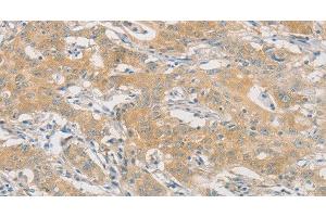 Immunohistochemistry of paraffin-embedded Human gasrtic cancer tissue using HIPK4 Polyclonal Antibody at dilution 1:30 (HIPK4 anticorps)