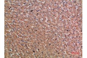 Immunohistochemical analysis of paraffin-embedded human-liver-cancer, antibody was diluted at 1:200