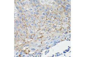 Immunohistochemistry of paraffin-embedded human esophageal cancer using CD147/CD147/BSG Rabbit pAb (ABIN3022146, ABIN3022147, ABIN1512647 and ABIN6218629) at dilution of 1:100 (40x lens).