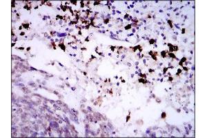 Immunohistochemical analysis of paraffin-embedded esophageal cancerwith DAB staining.