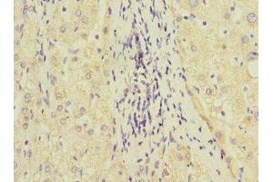 Immunohistochemistry of paraffin-embedded human liver cancer using ABIN7154098 at dilution of 1:100 (GSTK1 anticorps  (AA 1-226))