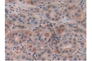 Detection of CLIC1 in Human Liver Cancer Tissue using Polyclonal Antibody to Chloride Intracellular Channel Protein 1 (CLIC1)