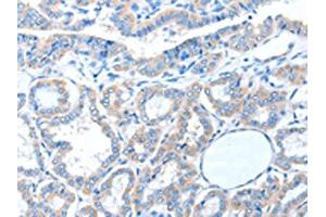 The image on the left is immunohistochemistry of paraffin-embedded Human thyroid cancer tissue using ABIN7128233(ADAM21 Antibody) at dilution 1/15, on the right is treated with fusion protein. (ADAM21 anticorps)