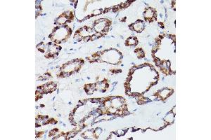 Immunohistochemistry of paraffin-embedded human thyroid cancer using L1 Rabbit pAb (ABIN6134555, ABIN6137248, ABIN6137250 and ABIN6215529) at dilution of 1:100 (40x lens).