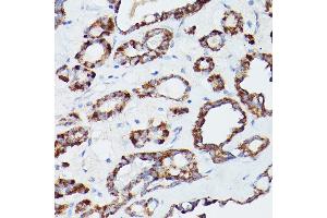 Immunohistochemistry of paraffin-embedded human thyroid cancer using L1 Rabbit pAb (ABIN6134555, ABIN6137248, ABIN6137250 and ABIN6215529) at dilution of 1:100 (40x lens). (ATG16L1 anticorps  (AA 200-300))