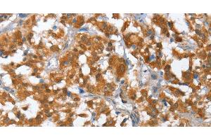 Immunohistochemistry of paraffin-embedded Human thyroid cancer using TP53BP2 Polyclonal Antibody at dilution of 1:35 (TP53BP2 anticorps)
