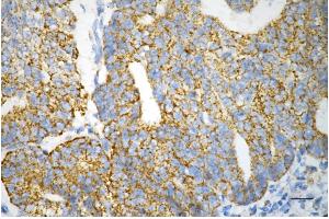 Immunohistochemistry was performed on paraffin-embedded human endometrial carcinoma using AIFM1 antibody (ABIN7797632), 1:200).