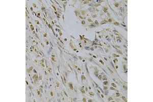 Immunohistochemistry of paraffin-embedded human gastric cancer using SUMO1 Antibody (ABIN5971157) at dilution of 1/200 (40x lens). (SUMO1 anticorps)