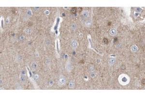 ABIN6278481 at 1/100 staining Human brain cancer tissue by IHC-P. (IL20RA anticorps  (C-Term))