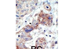 Formalin-fixed and paraffin-embedded human cancer tissue reacted with the primary antibody, which was peroxidase-conjugated to the secondary antibody, followed by DAB staining. (EPH Receptor B3 anticorps  (N-Term))