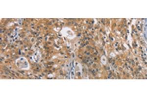 Immunohistochemistry of paraffin-embedded Human gastric cancer tissue using ZADH2 Polyclonal Antibody at dilution of 1:100(x200) (ZADH2 anticorps)