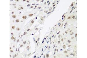 Immunohistochemistry of paraffin-embedded Human lung cancer using CBX3 Polyclonal Antibody at dilution of 1:200 (40x lens). (CBX3 anticorps)