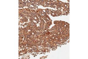 Immunohistochemical analysis of paraffin-embedded Human colon carcinoma tissue using (ABIN656331 and ABIN2845630) performed on the Leica® BOND RXm. (SLC16A3 anticorps  (C-Term))