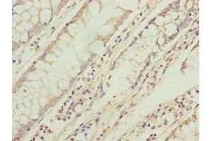 Immunohistochemistry of paraffin-embedded human colon cancer using ABIN7173269 at dilution of 1:100 (TMEM71 anticorps  (AA 1-210))
