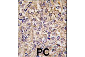 Formalin-fixed and paraffin-embedded human prostate carcinoma tissue reacted with IL1R1 polyclonal antibody  , which was peroxidase-conjugated to the secondary antibody, followed by DAB staining . (IL1RL2 anticorps  (C-Term))