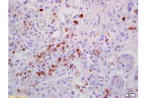 Formalin-fixed and paraffin embedded human lung carcinoma labeled with Anti-IL-7 Polyclonal Antibody, Unconjugated (ABIN734783) at 1:200 followed by conjugation to the secondary antibody and DAB staining (IL-7 anticorps  (AA 51-154))