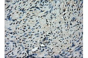 Immunohistochemical staining of paraffin-embedded Adenocarcinoma of ovary tissue using anti-TMEM100mouse monoclonal antibody. (TMEM100 anticorps)
