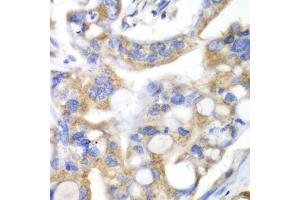 Immunohistochemistry of paraffin-embedded human liver cancer using PNLIP antibody (ABIN5975718) at dilution of 1/100 (40x lens). (PNLIP anticorps)