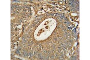 ACOX1 antibody immunohistochemistry analysis in formalin fixed and paraffin embedded human colon carcinoma