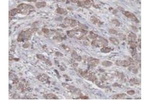 Detection of UBE2L3 in Human Breast Cancer Tissue using Polyclonal Antibody to Ubiquitin Conjugating Enzyme E2L3 (UBE2L3)