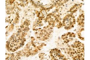 ABIN7094276 and ABIN7098323 at 1/100 staining Human lung cancer by IHC-P. (Histone Cluster 1, H1t (HIST1H1T) (Internal Region) anticorps)