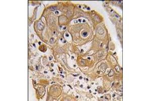 Formalin-fixed and paraffin-embedded human lung carcinoma tissue reacted with PTRF antibody (N-term), which was peroxidase-conjugated to the secondary antibody, followed by DAB staining.