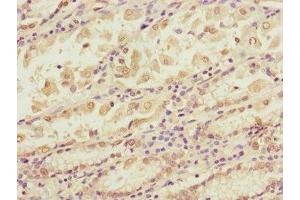 Immunohistochemistry of paraffin-embedded human gastric cancer using ABIN7145604 at dilution of 1:100 (BLOC1S2 anticorps  (AA 44-142))
