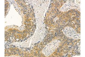 IREB1 Mouse Monoclonal Antibody at 1/100 staining human lung cancer and adjacent non-tumor tissue by IHC-P. (Aconitase 1 anticorps)