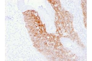Formalin-fixed, paraffin-embedded human Cervix Carcinoma stained with CD44v6 Mouse Monoclonal Antibody (2F10). (CD44 anticorps)