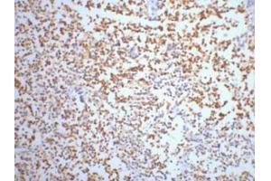 IHC staining of Human small cell carcinoma of lung tissue, diluted at 1:200.