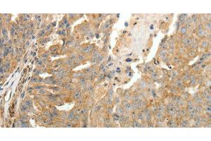 Immunohistochemistry of paraffin-embedded Human ovarian cancer tissue using SFTPD Polyclonal Antibody at dilution 1:30 (SFTPD anticorps)