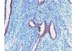 Formalin-fixed, paraffin-embedded human endometrial carcinoma stained with Cyclin B1 antibody (CCNB1/1098). (Cyclin B1 anticorps)