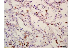 Formalin-fixed and paraffin embedded human lung carcinoma labeled with Anti-PPM1D Polyclonal Antibody, Unconjugated (ABIN740415) at 1:200 followed by conjugation to the secondary antibody and DAB staining (PPM1D anticorps  (AA 201-300))