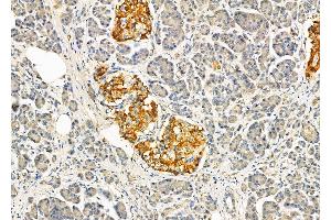 ABIN6264314 and ABIN6274038 at 1/100 staining Human pancreatic cancer and adjacent nomal tissues by IHC-P. (Melanoma gp100 anticorps  (C-Term))