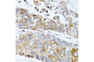 Immunohistochemistry of paraffin-embedded human lung cancer using PEX14 antibody. (PEX14 anticorps  (AA 118-377))