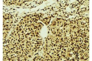 ABIN6274516 at 1/100 staining Human breast cancer tissue by IHC-P. (ZNF287 anticorps)