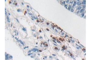 Detection of SEMA3E in Human Prostate cancer Tissue using Polyclonal Antibody to Semaphorin 3E (SEMA3E)