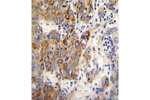 CYP2B6 Antibody immunohistochemistry analysis in formalin fixed and paraffin embedded human hepatocarcinoma followed by peroxidase conjugation of the secondary antibody and DAB staining. (CYP2B6 anticorps  (AA 235-263))