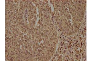 IHC image of ABIN7140106 diluted at 1:100 and staining in paraffin-embedded human cervical cancer performed on a Leica BondTM system.