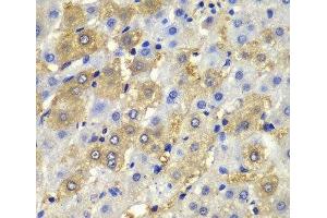 Immunohistochemistry of paraffin-embedded Human liver damage using Desmoplakin Polyclonal Antibody at dilution of 1:100 (40x lens). (Desmoplakin anticorps)