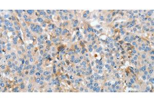 Immunohistochemistry of paraffin-embedded Human esophagus cancer using APOH Polyclonal Antibody at dilution of 1:30 (APOH anticorps)