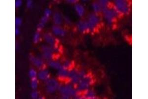 Immunofluorescence analysis of Human lung cancer tissue using CD68 Monoclonal Antibody at dilution of 1:200.