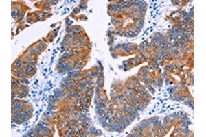 The image on the left is immunohistochemistry of paraffin-embedded Human colon cancer tissue using ABIN7130460(NR4A2 Antibody) at dilution 1/20, on the right is treated with fusion protein. (NR4A2 anticorps)