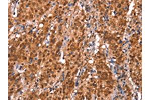The image on the left is immunohistochemistry of paraffin-embedded Human gastic cancer tissue using ABIN7191185(KCNJ6 Antibody) at dilution 1/20, on the right is treated with synthetic peptide.